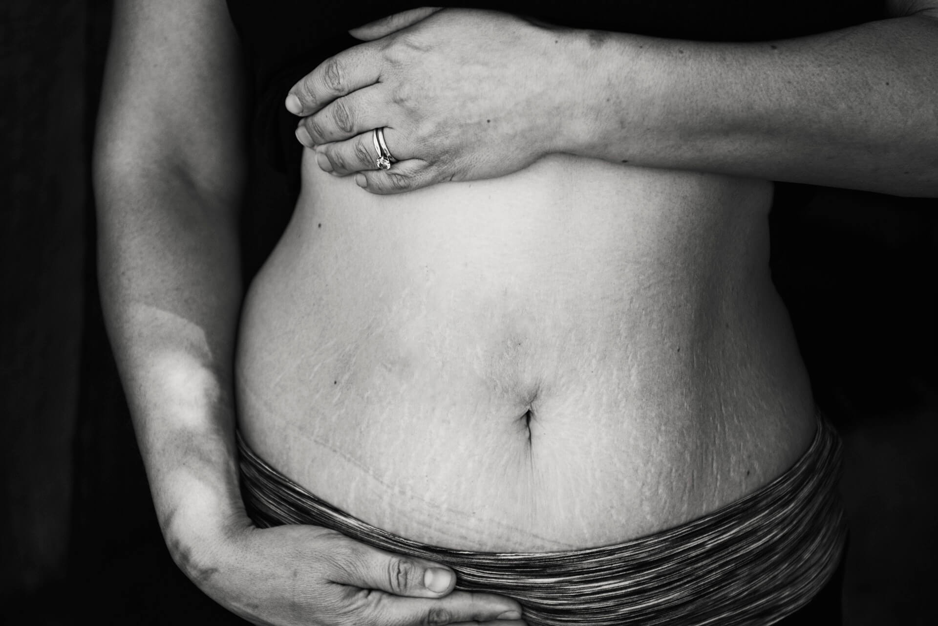 Belly with stretch marks | B3 Physical Therapy
