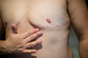Photo of scars left by gender-affirming top surgery.